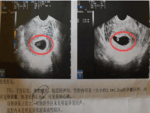 做孕囊检查主要是为了排除空孕囊