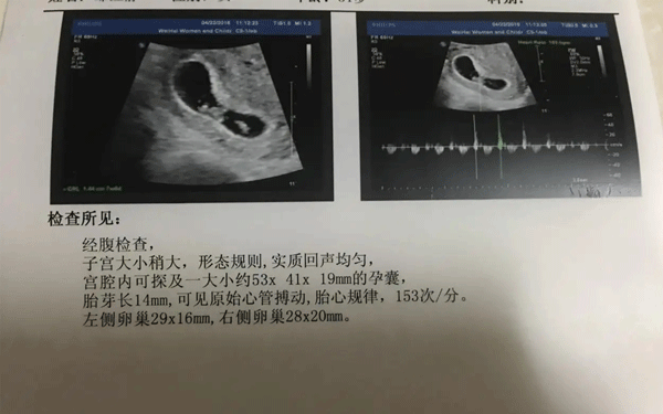 如果孕囊数据依次递减生女儿