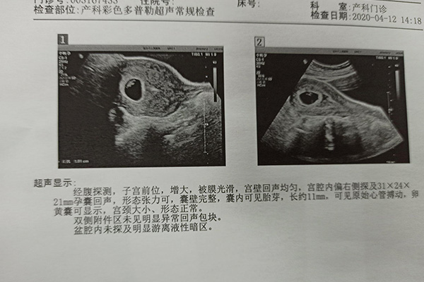 在孕7周左右可以通过B超观察到胎芽