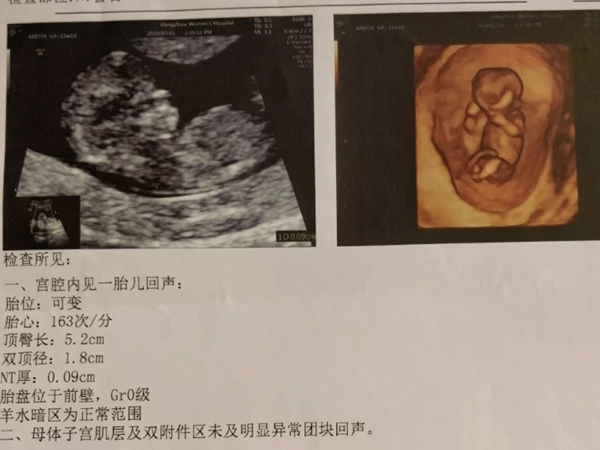 NT值1.2mm通常被认为是正常的