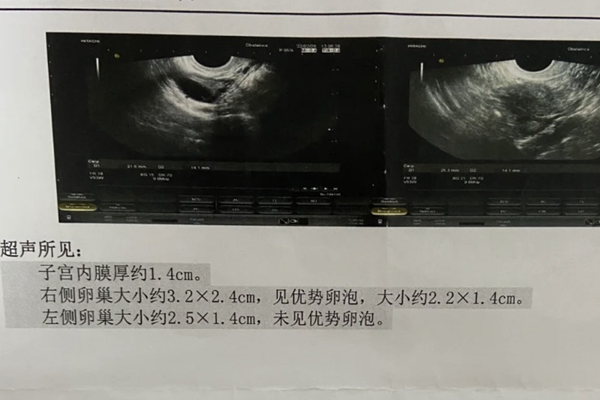 子宫内膜会影响试管成功率