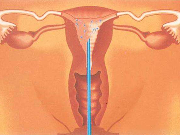 夫精人授技术妊娠率达17%