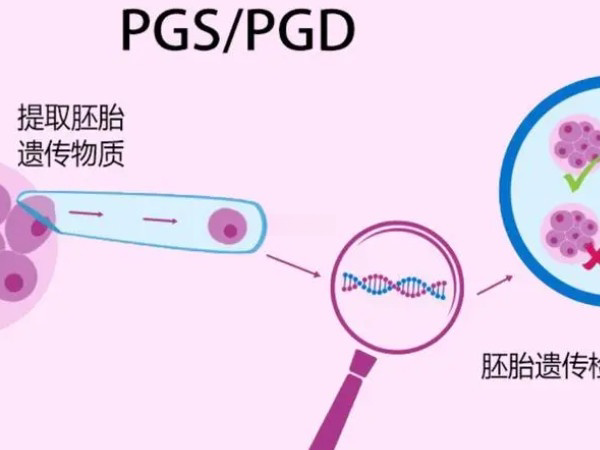 PGD筛查可筛选出健康胚胎