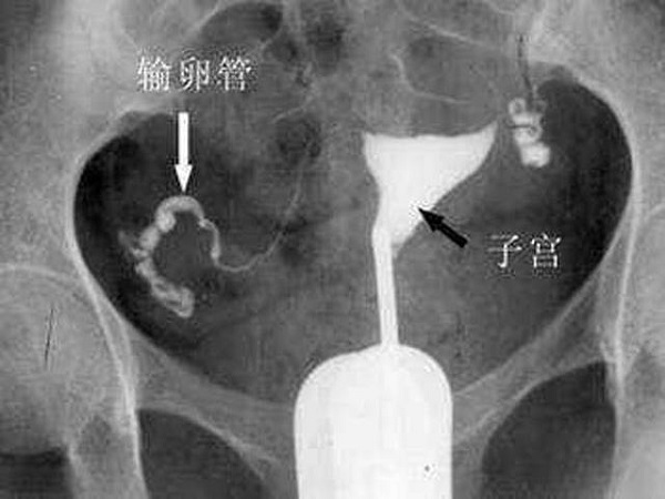 输卵管不通会导致不孕