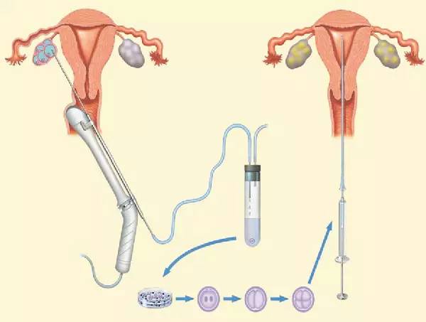 取卵术纳入了医保