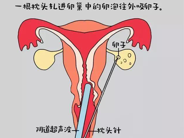 试管取卵手术费用2400元