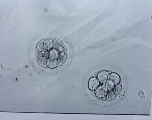 囊胚解冻失败与质量有关系