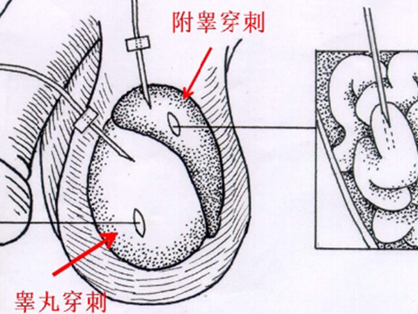 男方取精困难可使用睾丸穿刺术