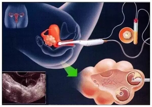 ‌取卵手术单次大概在一万元