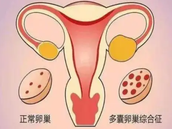 多囊卵巢可找王成瑜诊治