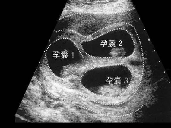 减胎手术要在孕10-12周之间进行