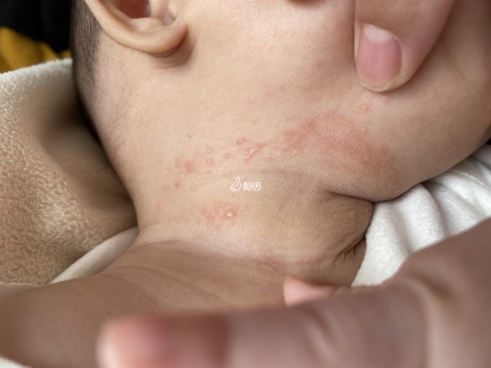 婴儿湿疹和尿布疹有较大区别