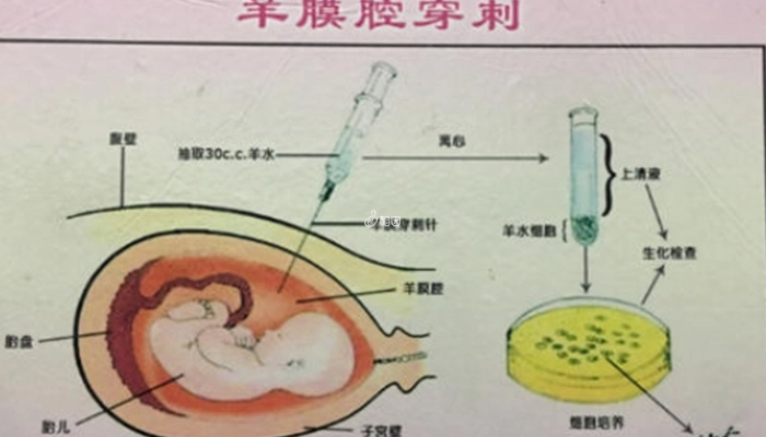 羊膜穿刺术可鉴定胎儿染色体