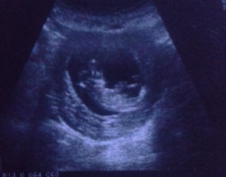 胎儿12周看不出助孕