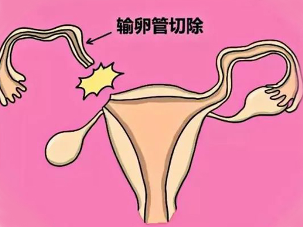 输卵管切除一侧还有自然怀孕的可能